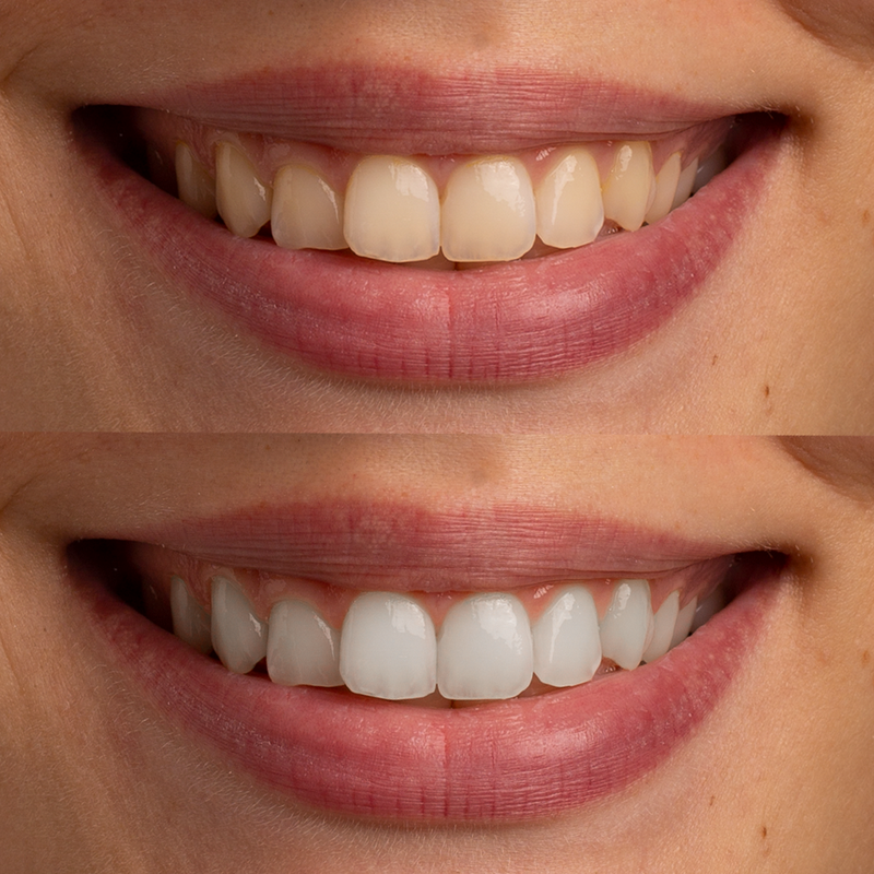 I've been using charcoal every other night for two weeks, and my coffee stains are completely gone. My teeth feel smooth to the touch and have a natural shine, without any sensitivity.